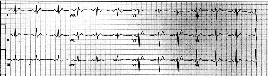 QT interval in an ECG of a human being of only 250 msec at a heart rate of 75 beats per minute.
