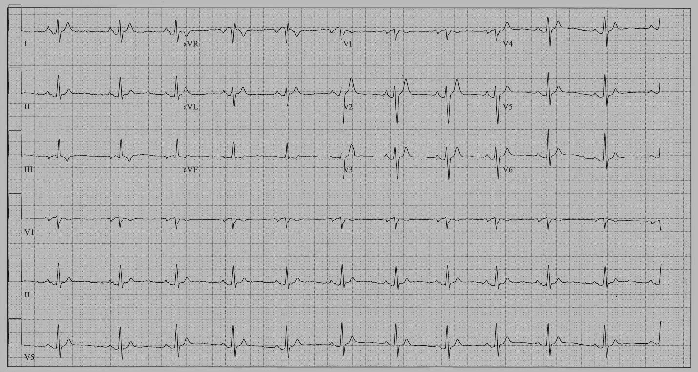 Twelve-lead surface ECG (paper speed 25 mm/sec and 10 mm/mV) from 16-year-old girl who was the first person to be diagnosed with SQTS. She was later found to have a KCNH2 mutation. The QT interval is 280 msec at a heart rate of 68 beats/min. PQ-segment depression < 0.05 mV from the isoelectric TP-segment is seen in leads I, aVL and V2-V6.