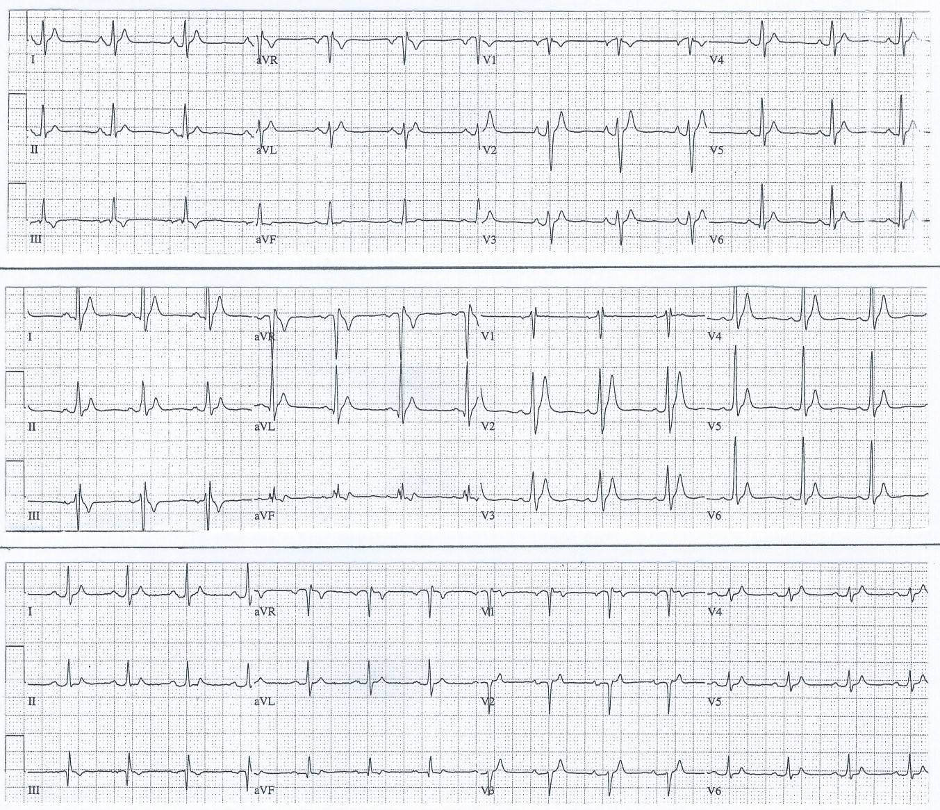 ECGs from first family diagnosed with Short QT Syndrome