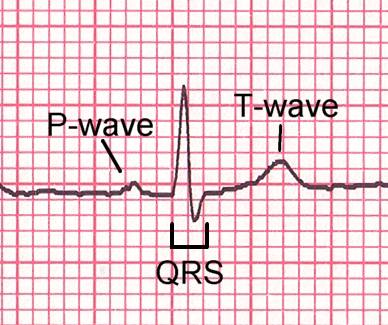 Each small square has a duration of 40 msec (Ex. A QT interval of 8 small squares (like in the above ECG) is 320 msec suggesting a short QT interval). A normal QT interval is between 360 and 450 msec).
